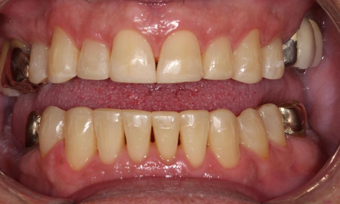 Ceramic Bonding Smile Gallery Before & After