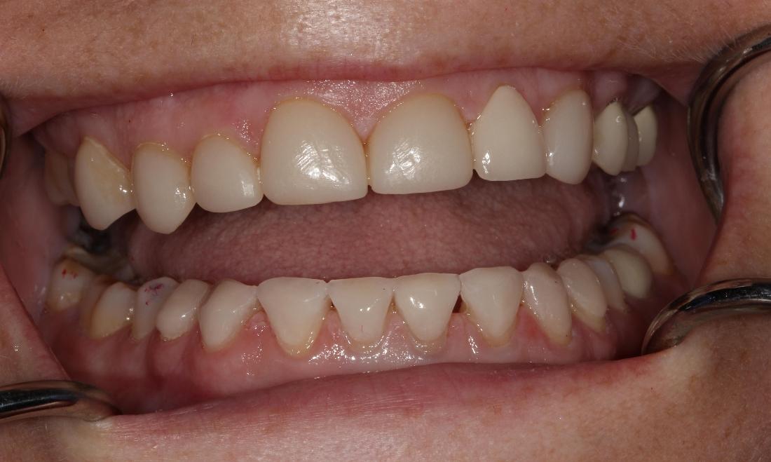 bright smile after ceramic veneers l ceramic veneers farmington nm