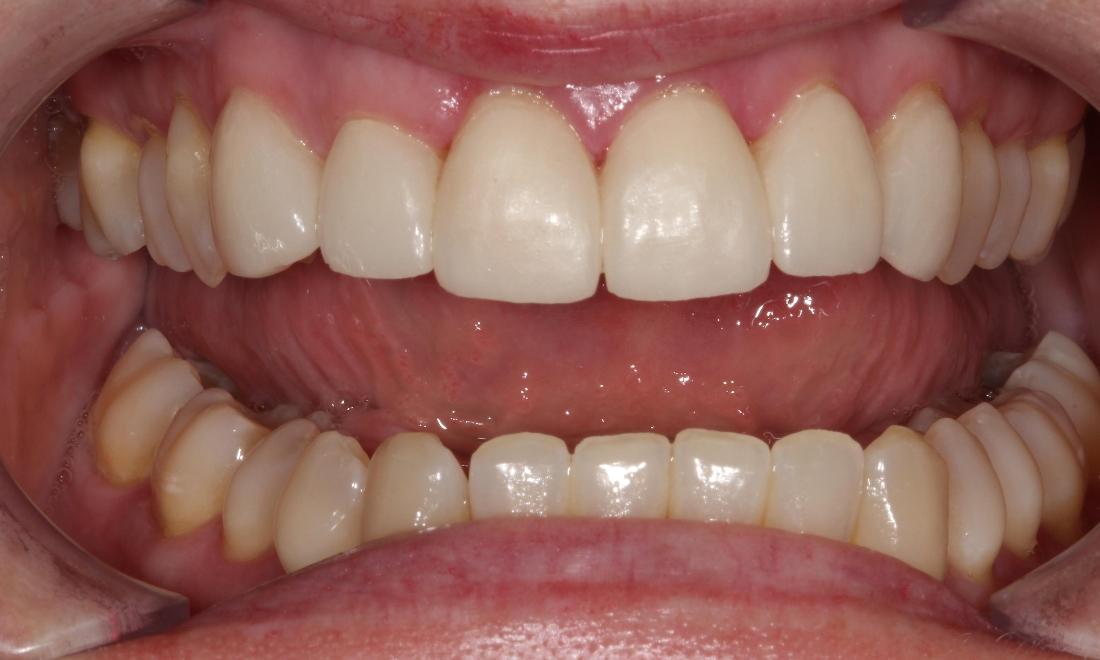 complete smile after ceramic veneers | dentist in farmington nm