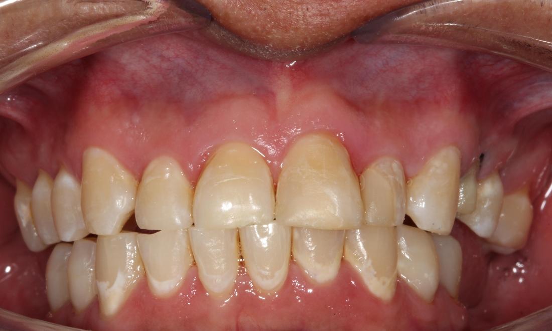 chipped tooth fixed after dental bonding | cosmetic bonding farmington nm