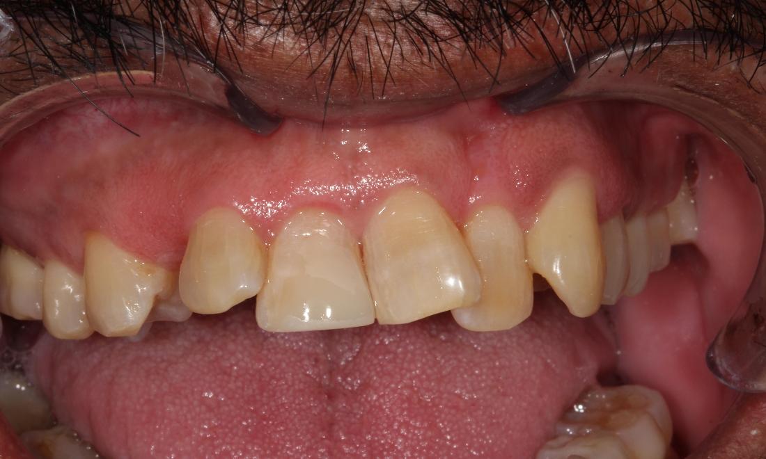 restored teeth after dental bonding | dental bonding farmington nm