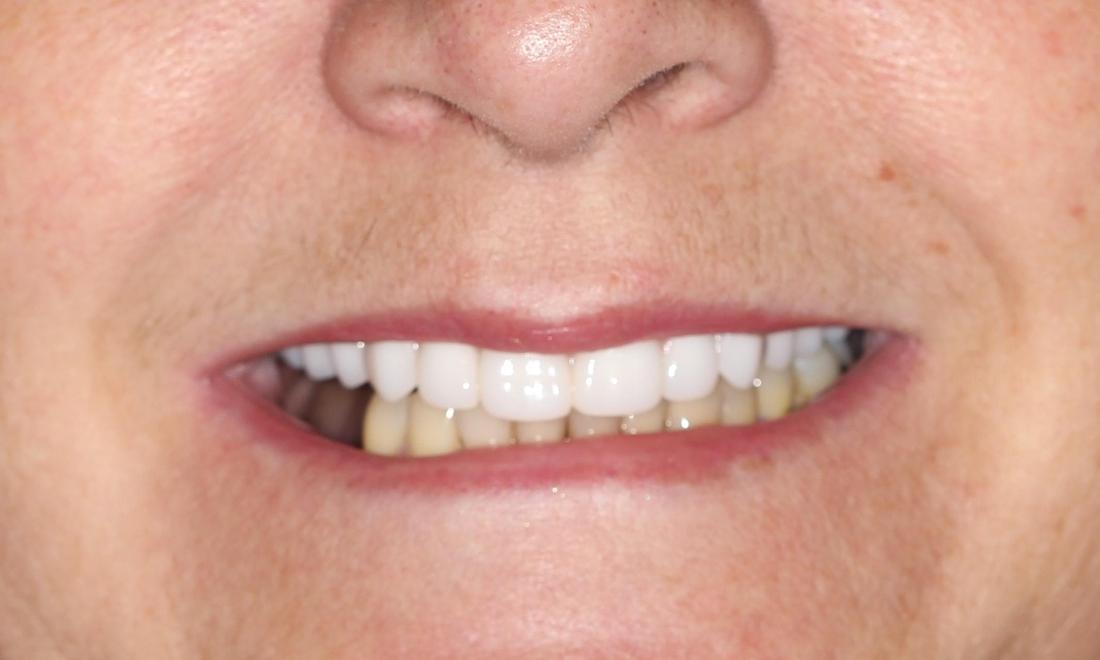 image of a smile fixed by dentures