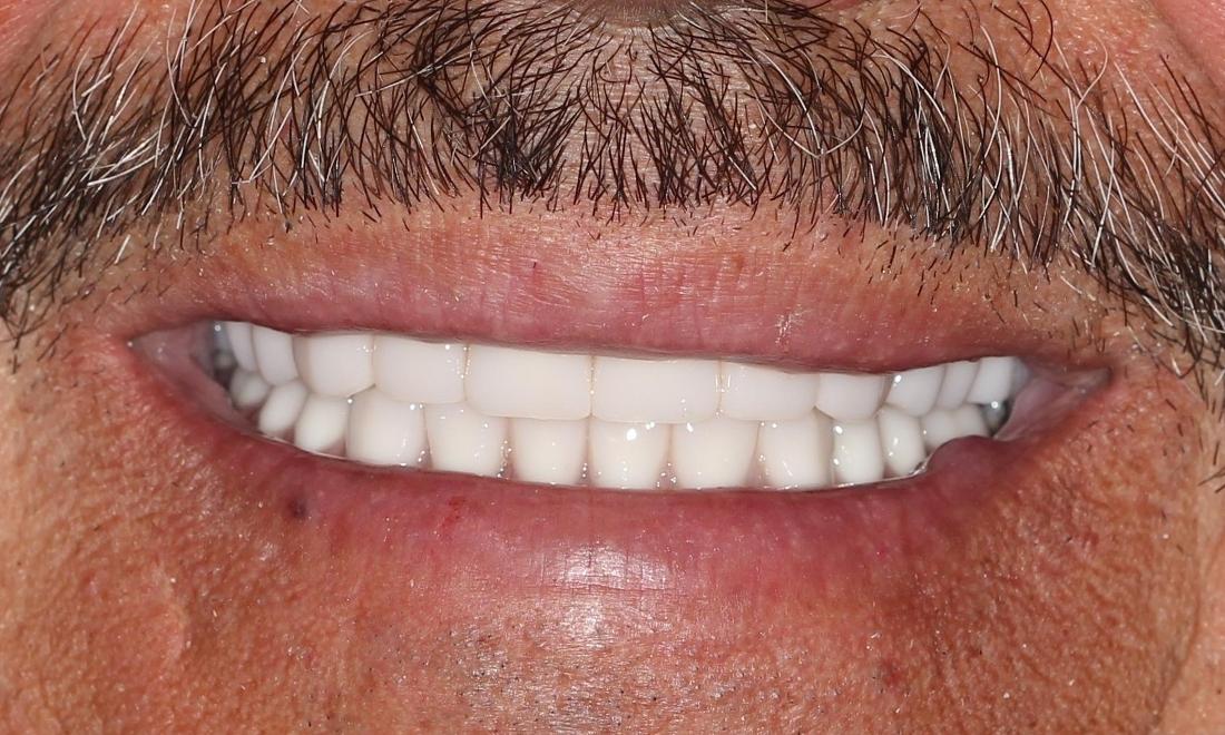 full upper and lower dentures farmington nm