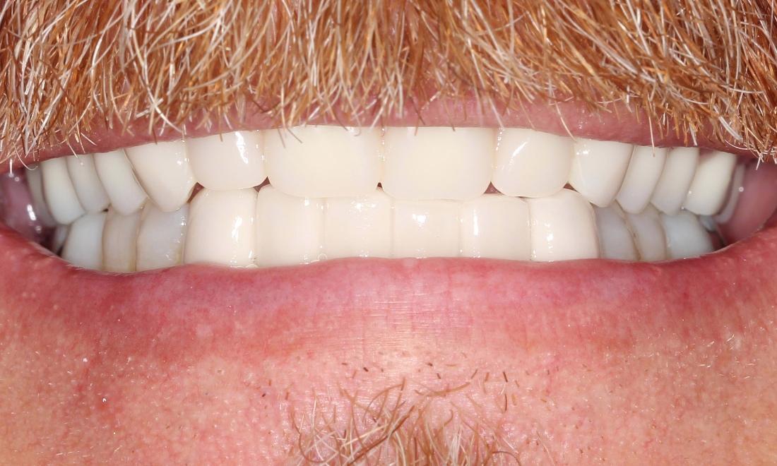 custom dentures farmington nm