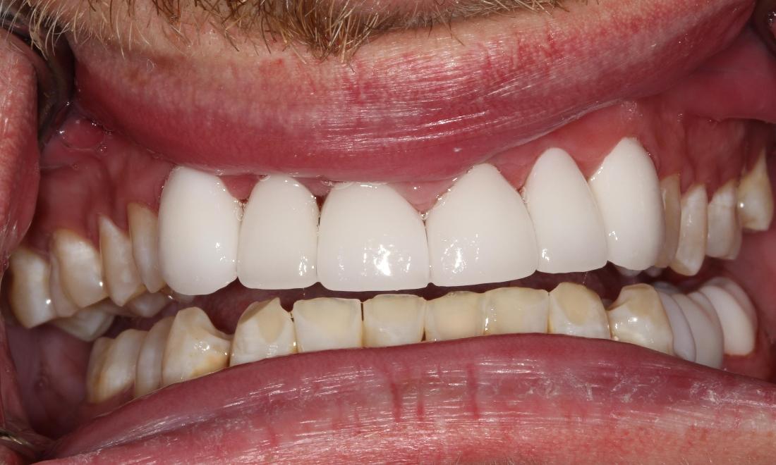 ceramic crowns farmington nm
