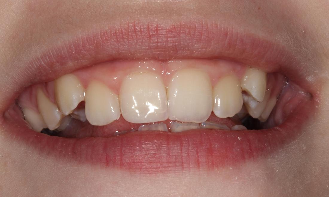 smiling after cosmetic dental bonding farmington nm