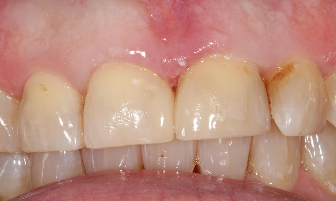 correct cavity treatment l dentist in farmington nm