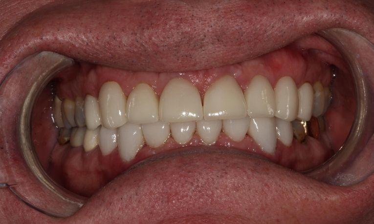 dental crowns ceramic nm