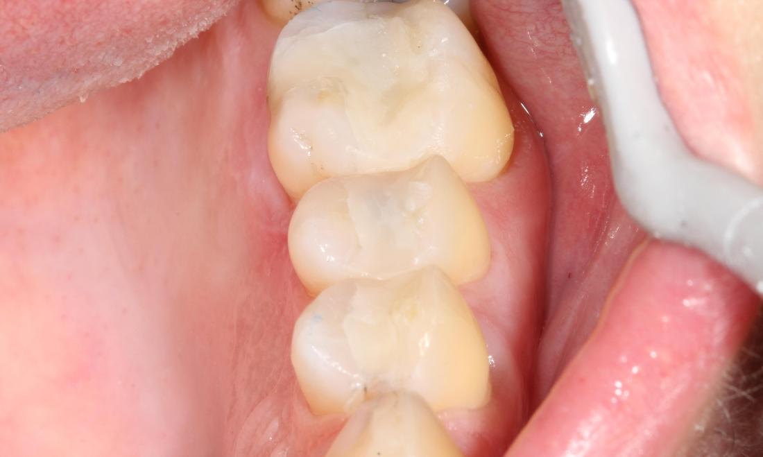 composite fillings after farmington nm