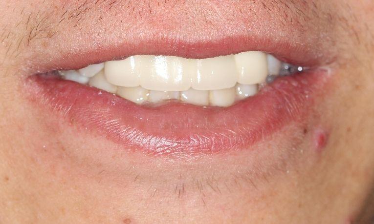 after fixed bridge | dental bridges farmington nm