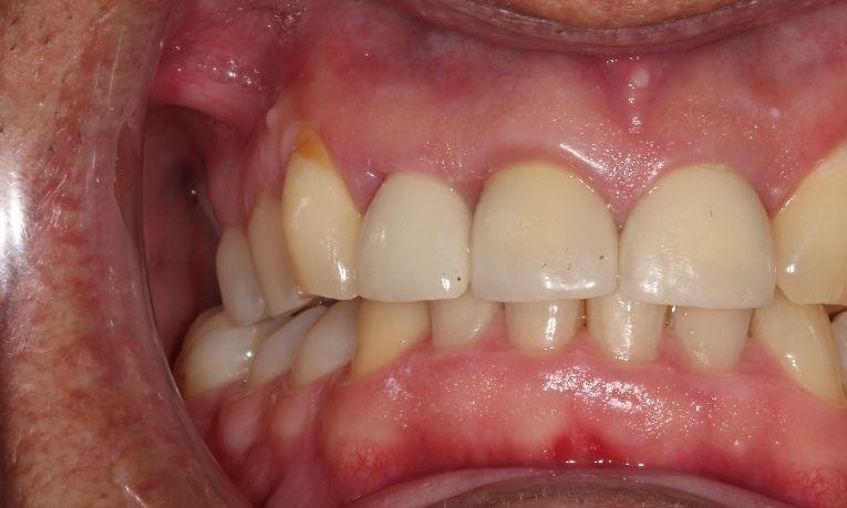 after ceramic crown | dental crowns farmington nm