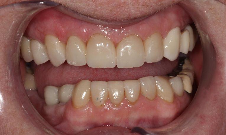 after image of patients smile | dental crowns farmington nm