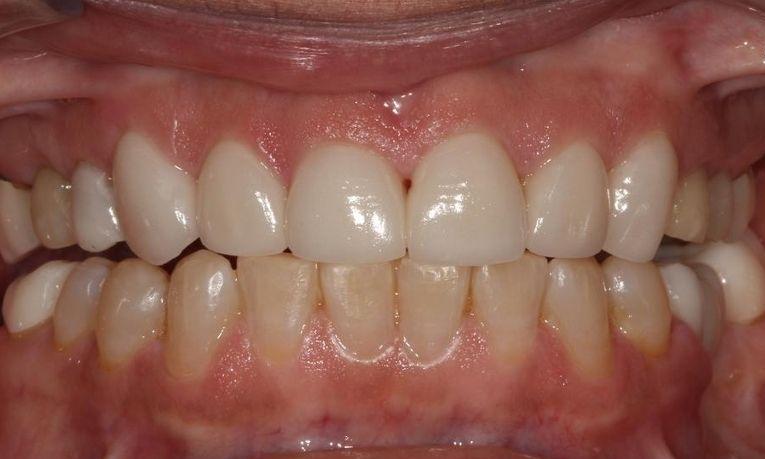 even smile after ceramic veneers | dental veneers farmington nm