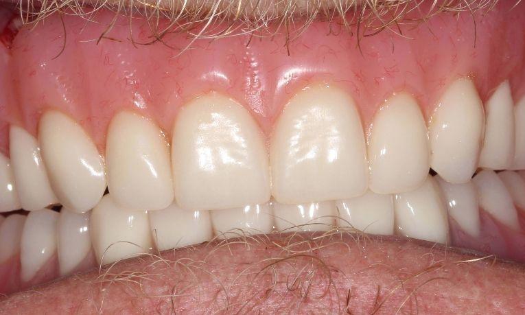 immediate dentures farmington nm
