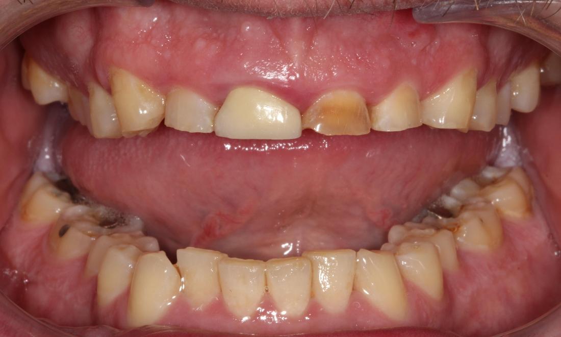 discolored teeth before ceramic crowns l dental crowns farmington nm