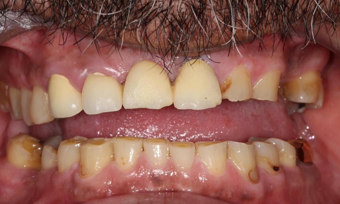 dental bridges | cover chipped broken teeth farmington nm