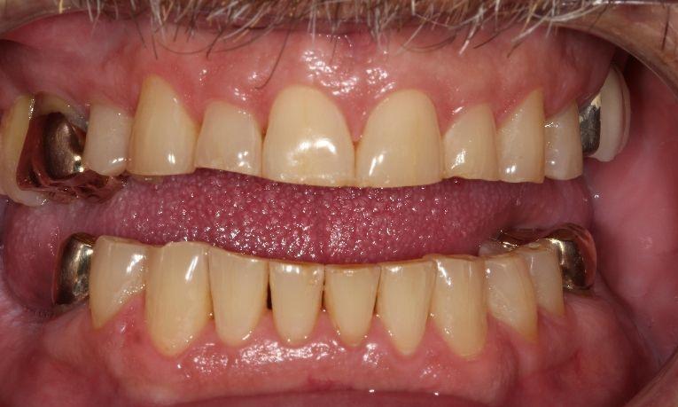 before ceramic bonding | dental bonding farmington nm