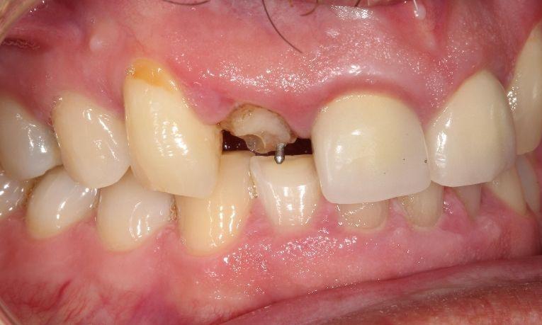 before ceramic crown | dental crowns farmington nm