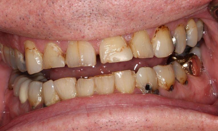 dental ceramic crowns farmington nm