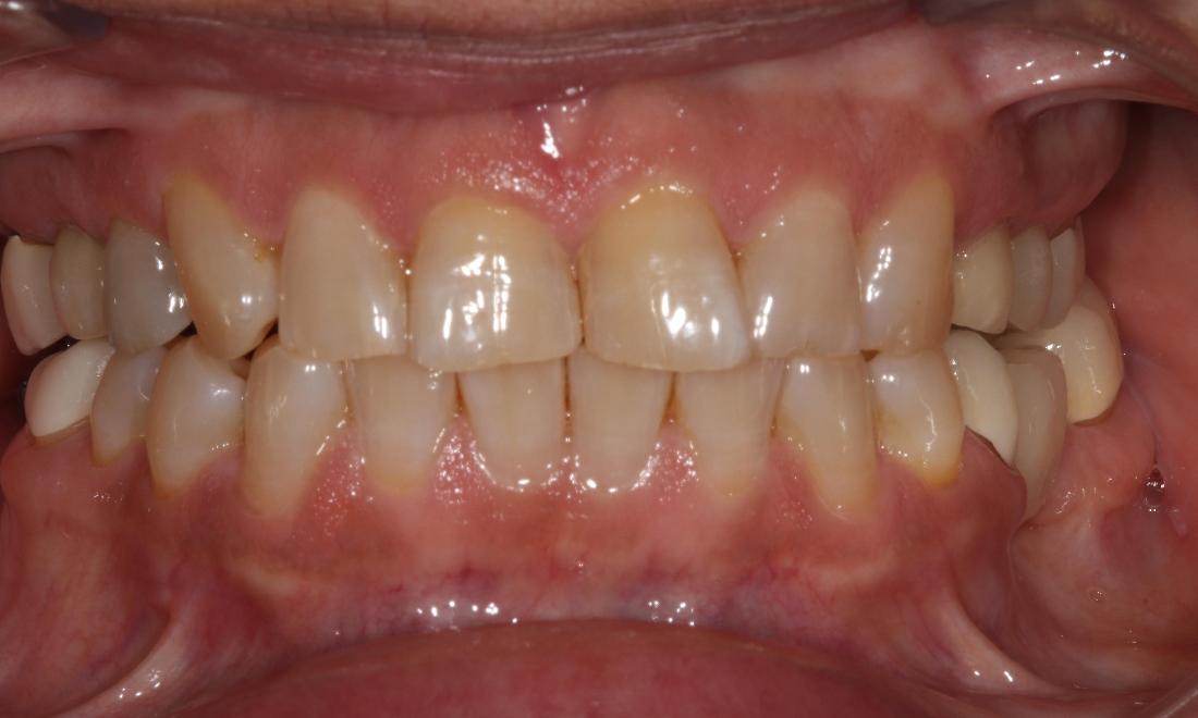 misshapen teeth before ceramic veneers l dentist in farmington nm