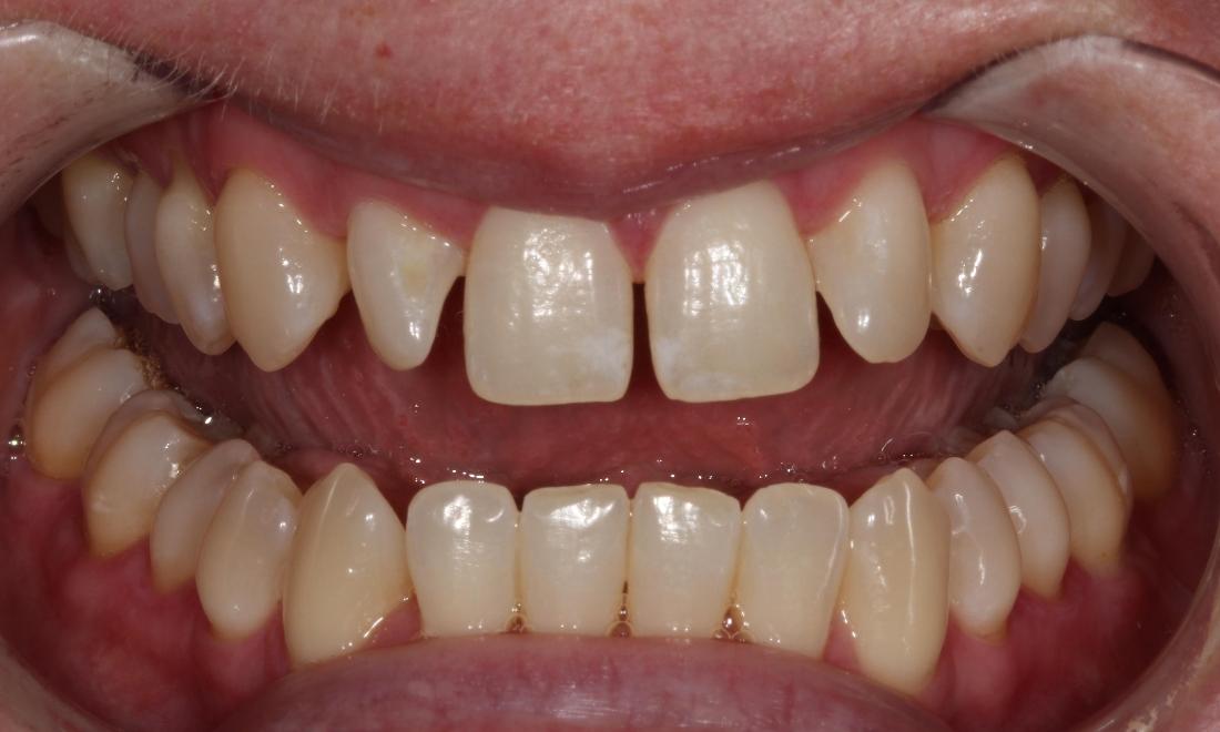 gapped teeth before ceramic veneers | veneers farmington nm