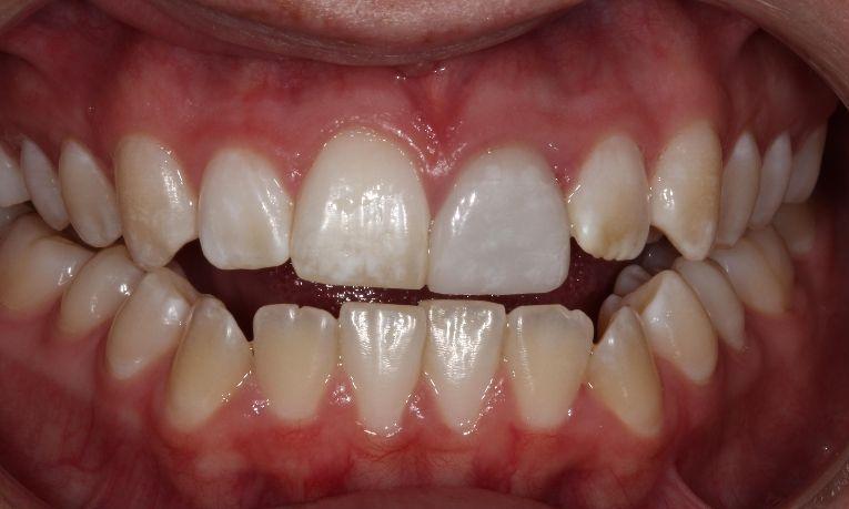 before veneers | veneers farmington nm