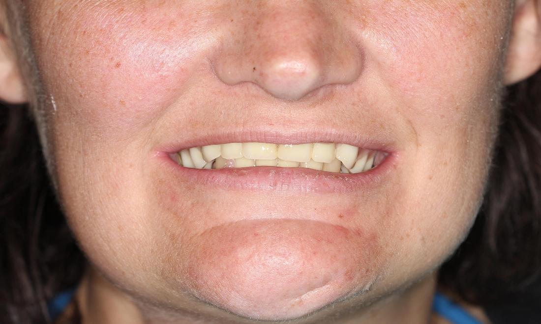 before custom dentures farmington nm