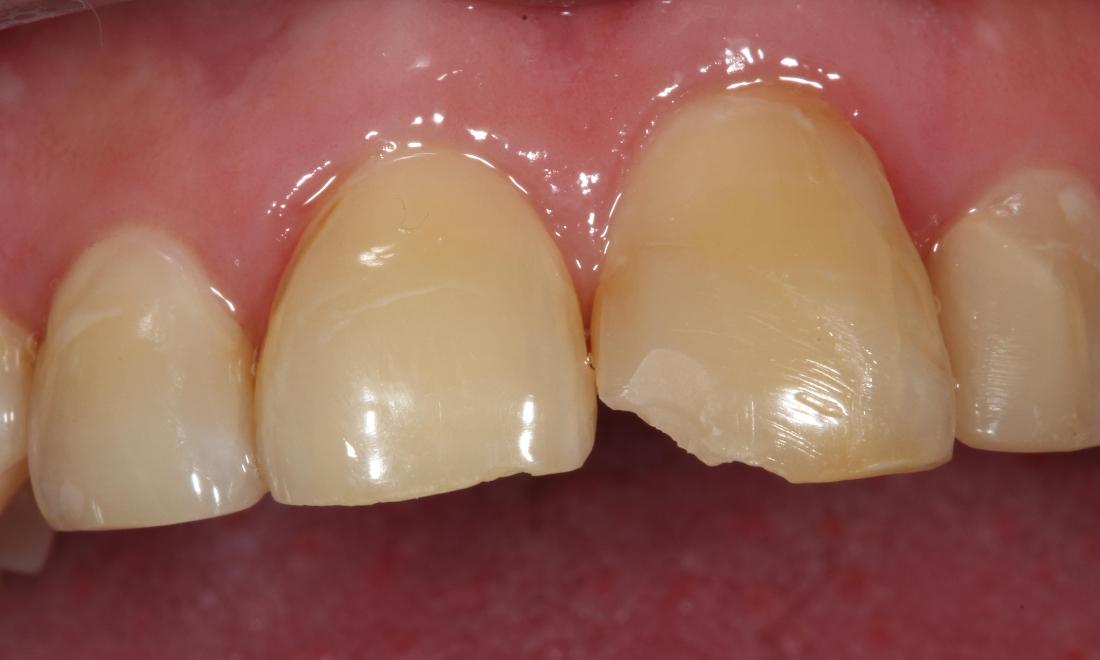 chipped tooth | before dental bonding farmington nm