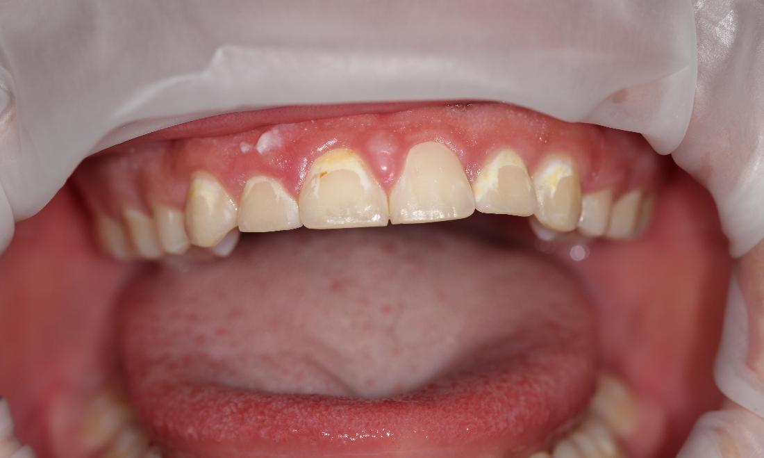 dingy teeth before bonding | dental bonding farmington nm