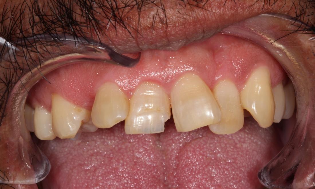 chipped teeth before dental bonding | cosmetic bonding farmington nm