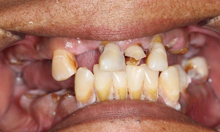 patient smile before dentures | dentures farmington nm