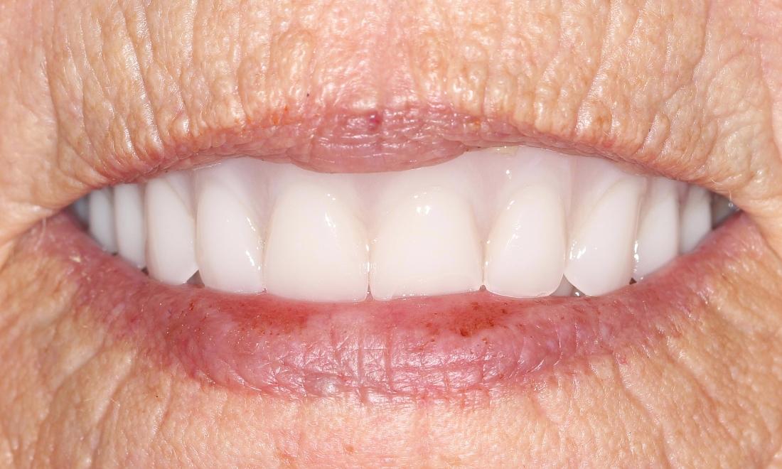before fittted custom dentures | custom dentures farmington nm