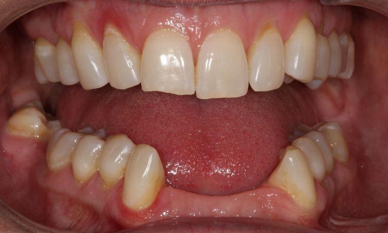 before dental bridge