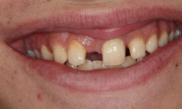before fixed bridge | dental bridges farmington nm
