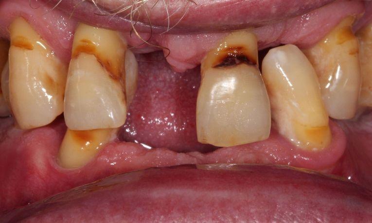 missing teeth and gum disease farmington nm