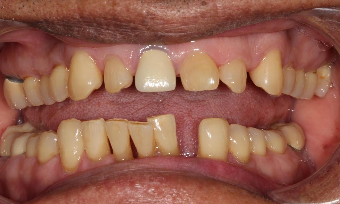 before gum disease treatment farmington nm