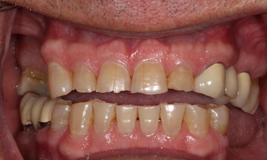 worn down teeth before ceramic crowns l dental crowns farmington nm