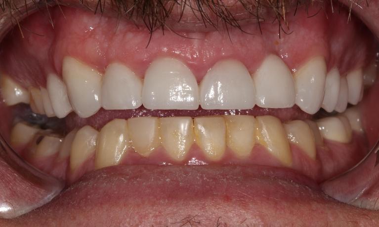 complete smile after ceramic crowns l dentist in farmington nm