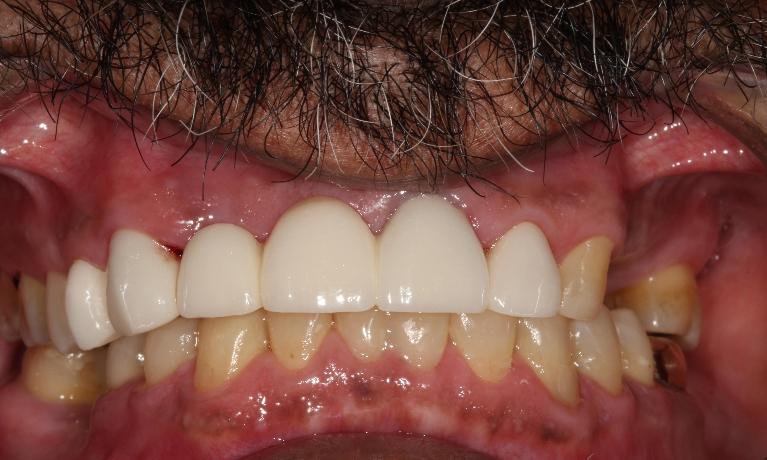 dental bridges | covering chipped and broken teeth farmington nm