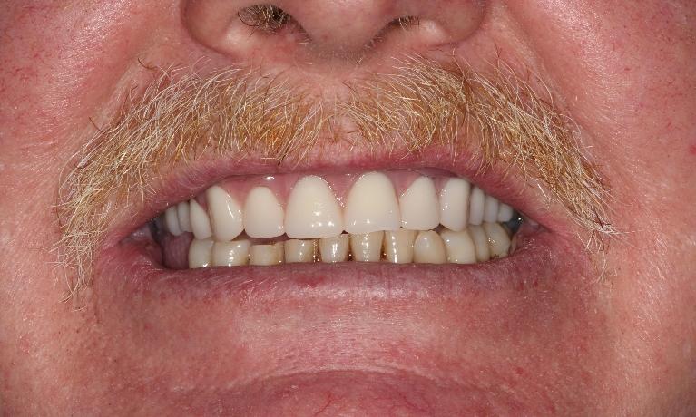 full upper dentures farmington nm