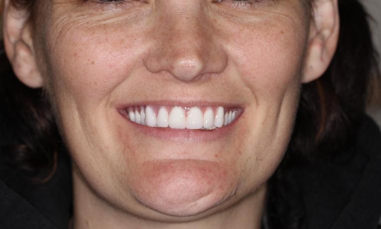 after custom dentures farmington nm