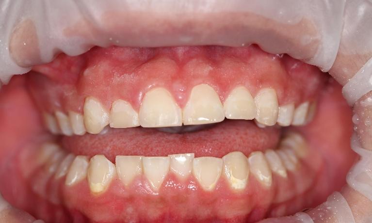 bright smile after bonding | cosmetic dentistry in farmington nm