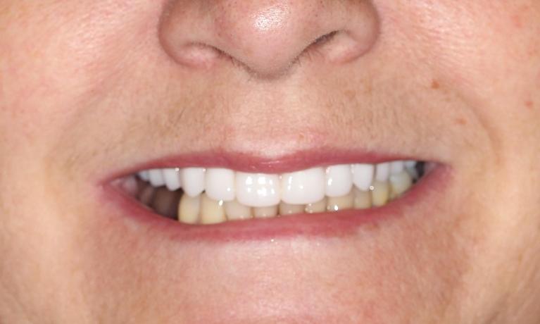 Custom-Denture-After-Image