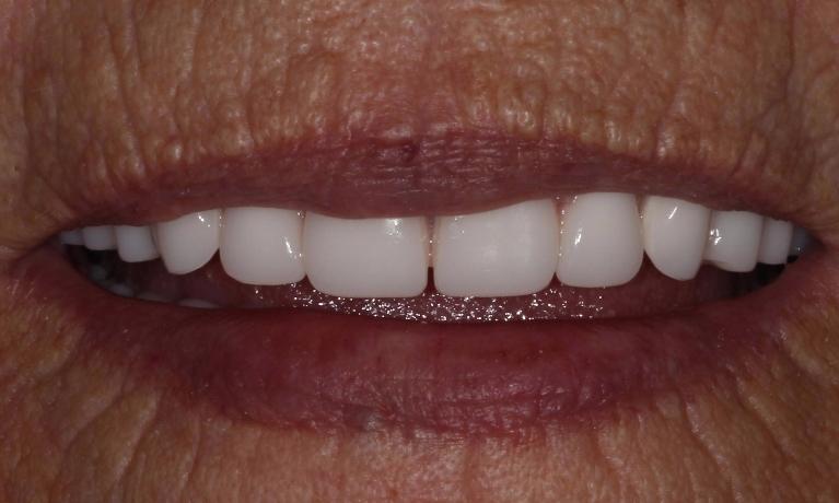 after fitted custom dentures | fitted dentures farmington nm