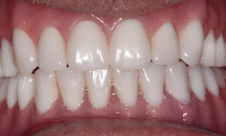 dental implant supported dentures farmington nm