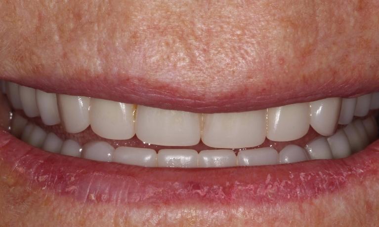 Dental-Implant-Secured-Denture-After-Image