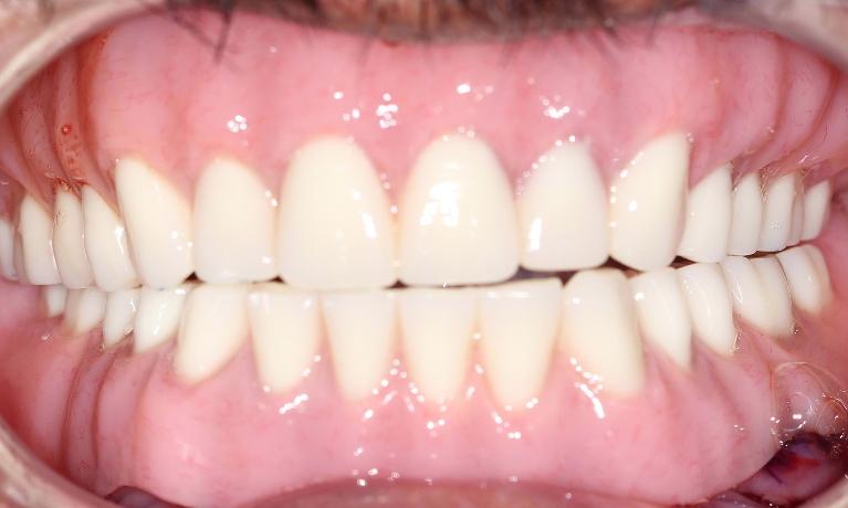 teeth replacement options farmington nm