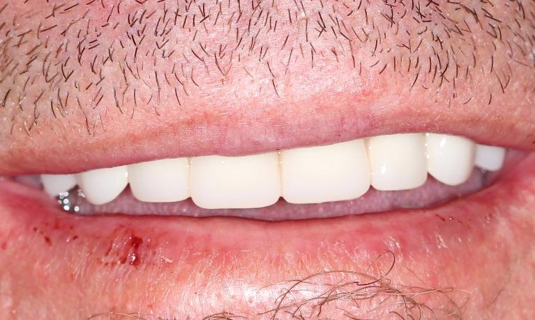 after dentures | full dentures farmington nm