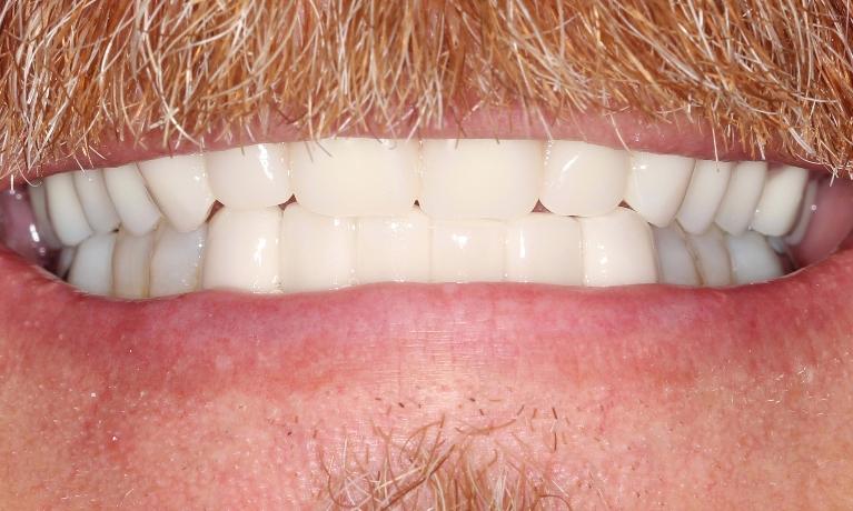 custom dentures farmington nm