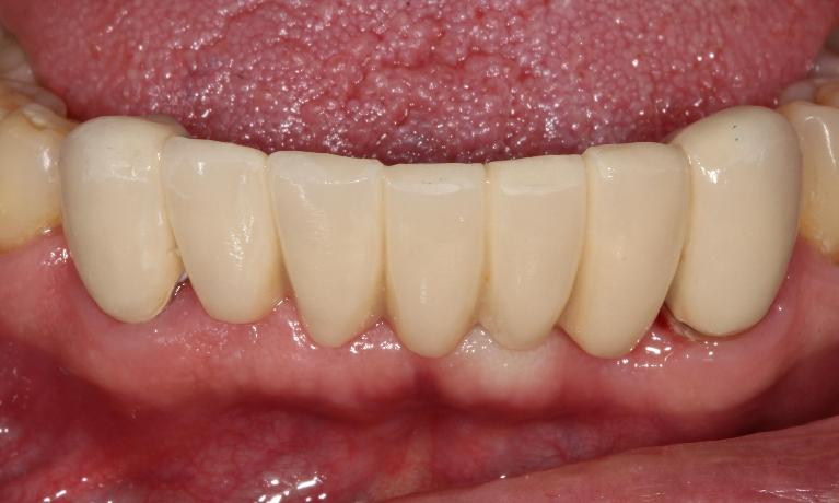 Periodontal-disease-extractions-bridge-and-tooth-replacement-After-Image